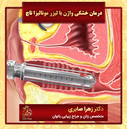 درمان-خشکی-واژن-با-لیزر-مونالیزا-تاچ