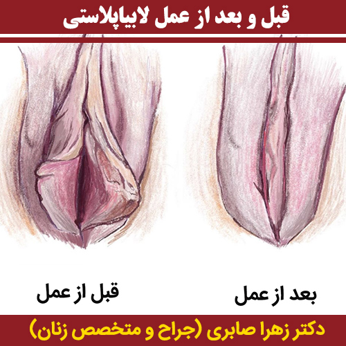 قبل-و-بعد-از-عمل-لابیاپلاستی