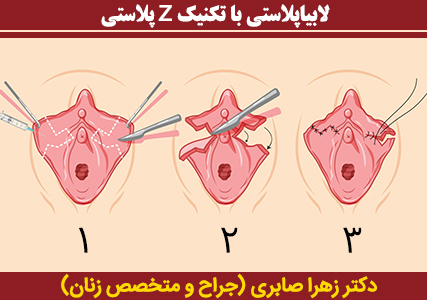 لابیاپلاستی-با-تکنیک-z-پلاستی