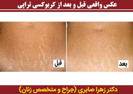 عکس-واقعی-قبل-و-بعد-از-کربوکسی-تراپی