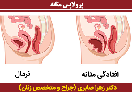پرولاپس-مثانه