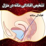 تشخیص-افتادگی-مثانه-در-منزل