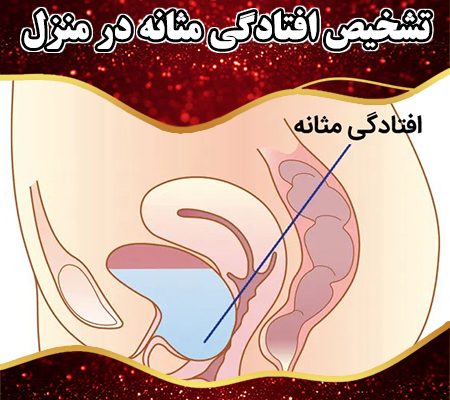 تشخیص-افتادگی-مثانه-در-منزل