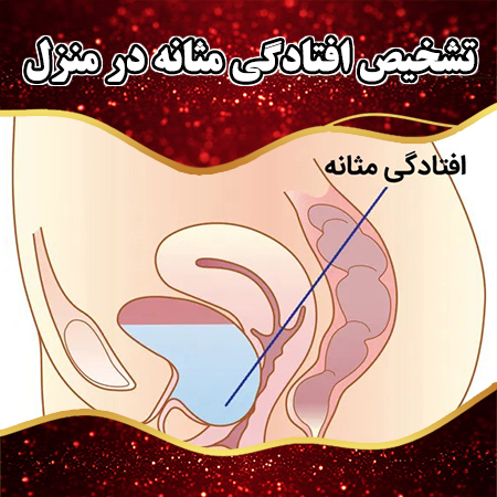 تشخیص-افتادگی-مثانه-در-منزل