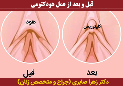قبل-و-بعد-از-عمل-هودکتومی