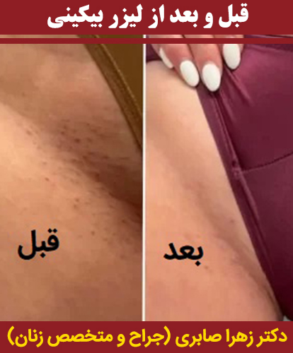 قبل-و-بعد-از-لیزر-بیکینی