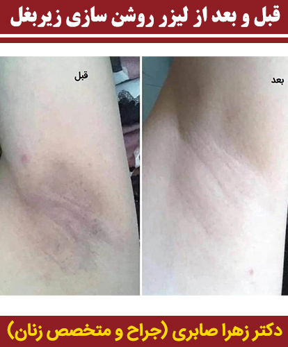 قبل-و-بعد-از-لیزر-روشن-سازی-زیربغل