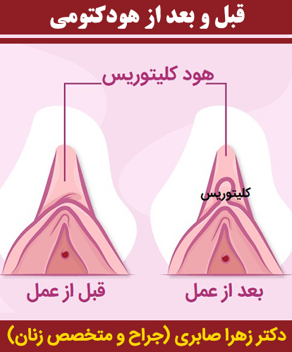 قبل-و-بعد-از-هودکتومی