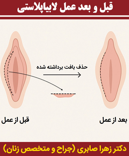 قبل-و-بعد-عمل-لابیاپلاستی