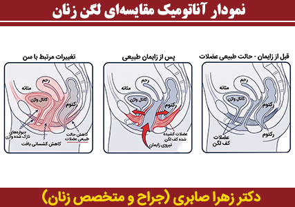 نمودار آناتومیک مقایسه‌ای لگن زنان که سه وضعیت مختلف را نشان می‌دهد: حالت طبیعی عضلات کف لگن قبل از زایمان، کشیدگی عضلات در اثر نیروی زایمان طبیعی، و نازک شدن دیواره‌ها و کاهش کشسانی بافت واژن به دلیل تغییرات مرتبط با سن